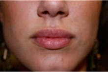 Dermal Fillers After Photo by Mariam Awada, MD, FACS; Southfield, MI - Case 40254