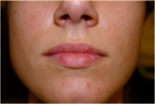 Dermal Fillers Before Photo by Mariam Awada, MD, FACS; Southfield, MI - Case 40254