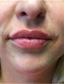 Dermal Fillers After Photo by Mariam Awada, MD, FACS; Southfield, MI - Case 40256
