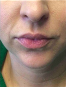 Dermal Fillers Before Photo by Mariam Awada, MD, FACS; Southfield, MI - Case 40256