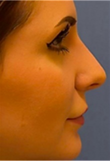 Dermal Fillers After Photo by Mariam Awada, MD, FACS; Southfield, MI - Case 40262