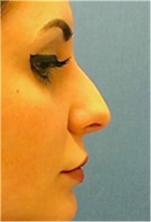 Dermal Fillers Before Photo by Mariam Awada, MD, FACS; Southfield, MI - Case 40262