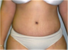 Tummy Tuck After Photo by Mariam Awada, MD, FACS; Southfield, MI - Case 40312