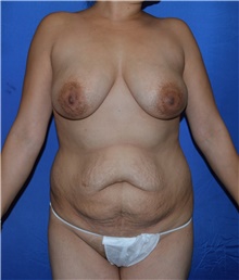 Mommy Makeover Before Photo by Karol Gutowski, MD, FACS; Glenview, IL - Case 40582