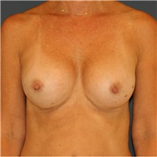 Breast Augmentation After Photo by Steve Laverson, MD, FACS; Rancho Santa Fe, CA - Case 40629