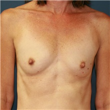 Breast Augmentation Before Photo by Steve Laverson, MD, FACS; Rancho Santa Fe, CA - Case 40629