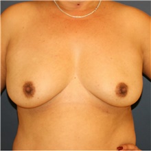 Breast Augmentation Before Photo by Steve Laverson, MD, FACS; Rancho Santa Fe, CA - Case 40711