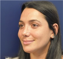 Rhinoplasty After Photo by Richard Reish, MD, FACS; New York, NY - Case 40743