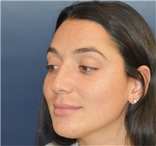 Rhinoplasty Before Photo by Richard Reish, MD, FACS; New York, NY - Case 40743