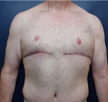 Male Breast Reduction After Photo by Michael Dobryansky, MD, FACS; Garden City, NY - Case 40845