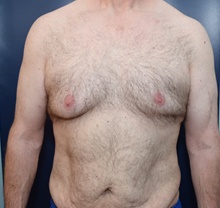 Male Breast Reduction Before Photo by Michael Dobryansky, MD, FACS; Garden City, NY - Case 40845