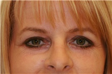 Brow Lift After Photo by Steve Laverson, MD, FACS; Rancho Santa Fe, CA - Case 40970