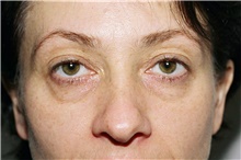 Eyelid Surgery Before Photo by Steve Laverson, MD, FACS; Rancho Santa Fe, CA - Case 41005