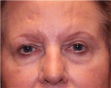 Eyelid Surgery Before Photo by Jennifer Greer, MD; Mentor, OH - Case 41077