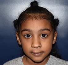 Cleft Lip and Palate Repair After Photo by Rachel Ruotolo, MD; Garden City, NY - Case 41336