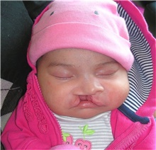 Cleft Lip and Palate Repair Before Photo by Rachel Ruotolo, MD; Garden City, NY - Case 41336