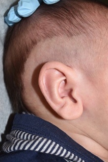 Ear Surgery After Photo by Rachel Ruotolo, MD; Garden City, NY - Case 41349