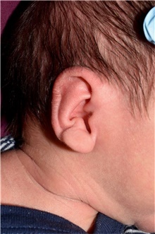 Ear Surgery Before Photo by Rachel Ruotolo, MD; Garden City, NY - Case 41349