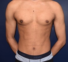 Male Breast Reduction After Photo by Rachel Ruotolo, MD; Garden City, NY - Case 41355