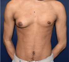 Male Breast Reduction Before Photo by Rachel Ruotolo, MD; Garden City, NY - Case 41355