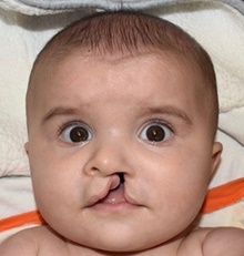 Cleft Lip and Palate Repair Before Photo by Rachel Ruotolo, MD; Garden City, NY - Case 41376