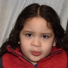 Cleft Lip and Palate Repair After Photo by Rachel Ruotolo, MD; Garden City, NY - Case 41382