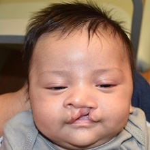 Cleft Lip and Palate Repair Before Photo by Rachel Ruotolo, MD; Garden City, NY - Case 41382