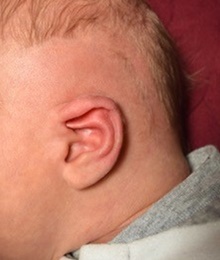 Ear Surgery Before Photo by Rachel Ruotolo, MD; Garden City, NY - Case 41386