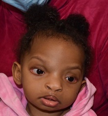 Cleft Lip and Palate Repair After Photo by Rachel Ruotolo, MD; Garden City, NY - Case 41393