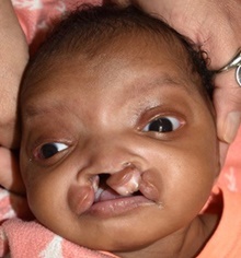 Cleft Lip and Palate Repair Before Photo by Rachel Ruotolo, MD; Garden City, NY - Case 41393