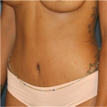 Tummy Tuck After Photo by Steve Laverson, MD, FACS; Rancho Santa Fe, CA - Case 41463