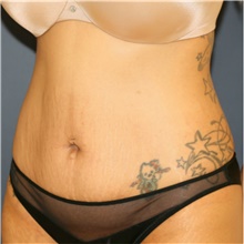 Tummy Tuck Before Photo by Steve Laverson, MD, FACS; Rancho Santa Fe, CA - Case 41463