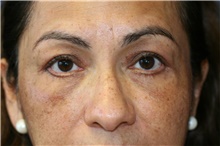 Eyelid Surgery After Photo by Steve Laverson, MD, FACS; Rancho Santa Fe, CA - Case 41465