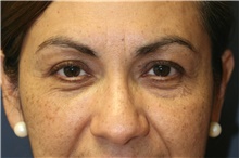 Eyelid Surgery Before Photo by Steve Laverson, MD, FACS; Rancho Santa Fe, CA - Case 41465