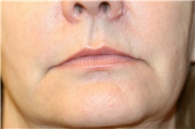 Lip Augmentation/Enhancement Before Photo by Steve Laverson, MD, FACS; Rancho Santa Fe, CA - Case 41513
