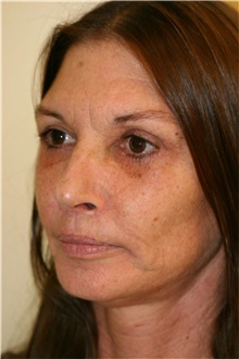 Facelift After Photo by Steve Laverson, MD, FACS; Rancho Santa Fe, CA - Case 41562