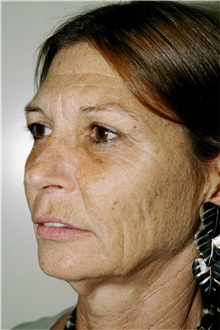 Facelift Before Photo by Steve Laverson, MD, FACS; Rancho Santa Fe, CA - Case 41562