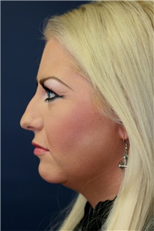 Rhinoplasty Before Photo by Steve Laverson, MD, FACS; Rancho Santa Fe, CA - Case 41571