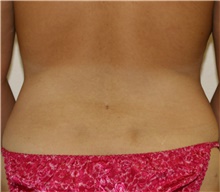 Liposuction After Photo by Steve Laverson, MD, FACS; Rancho Santa Fe, CA - Case 41586
