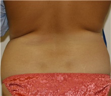 Liposuction Before Photo by Steve Laverson, MD, FACS; Rancho Santa Fe, CA - Case 41586