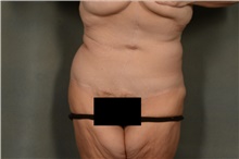 Tummy Tuck After Photo by Ellen Janetzke, MD; Bloomfield Hills, MI - Case 41668