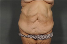 Tummy Tuck Before Photo by Ellen Janetzke, MD; Bloomfield Hills, MI - Case 41668
