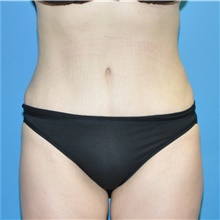 Tummy Tuck After Photo by Joshua Cooper, MD; Seattle, WA - Case 41801