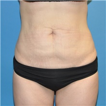 Tummy Tuck Before Photo by Joshua Cooper, MD; Seattle, WA - Case 41801