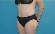 Tummy Tuck After Photo by Scott Sattler, MD,  FACS; Seattle, WA - Case 41864