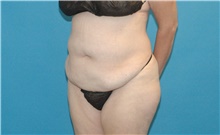 Tummy Tuck Before Photo by Scott Sattler, MD,  FACS; Seattle, WA - Case 41864