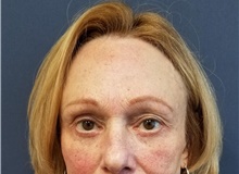 Eyelid Surgery After Photo by Noel Natoli, MD, FACS; East Hills, NY - Case 41897