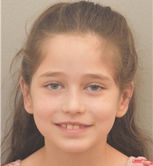 Ear Surgery After Photo by Keshav Magge, MD; Bethesda, MD - Case 41949