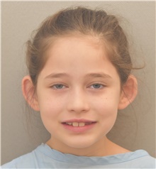 Ear Surgery Before Photo by Keshav Magge, MD; Bethesda, MD - Case 41949