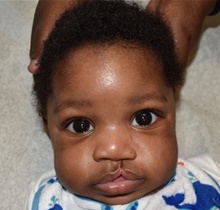 Cleft Lip and Palate Repair Before Photo by Rachel Ruotolo, MD; Garden City, NY - Case 41957